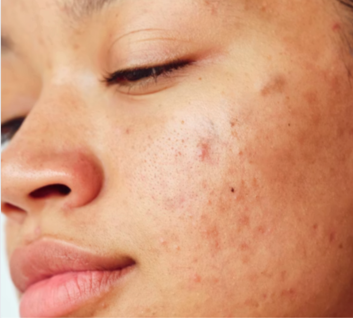 Le collagène Apnée