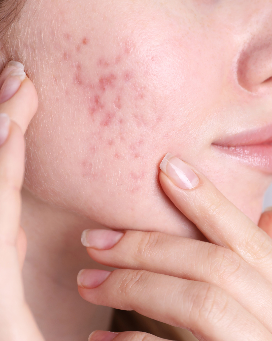 Le collagène Apnée